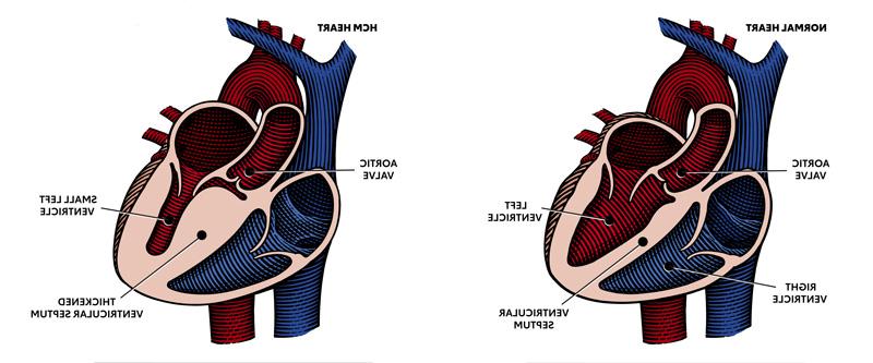 Diagram showing normal heart and one with HCM